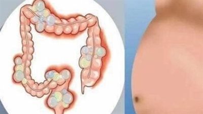 علاج انتفاخ القولون