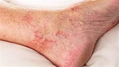علاج الخطوط الحمراء في الجسم: نصائح وحلول