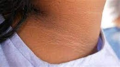 تخلصي من سواد الرقبة نهائيًا بهذه الطر