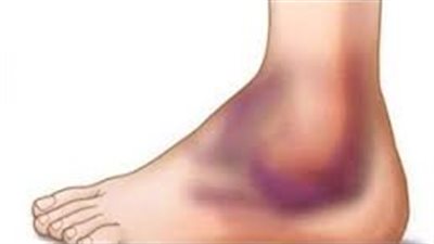 كدمات القدم: كيفية علاجها والتخلص منها بسرعة