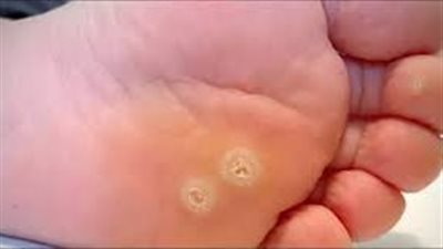 حبوب أسفل القدم: ما هي أسبابها وعلاجها؟