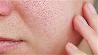 وداعاً لاحمرار الوجه: تخلصي من احمرار بشرتك المزعج!