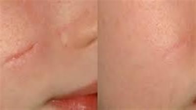  5 طرق طبيعية للتخلص من الندوب القديمة