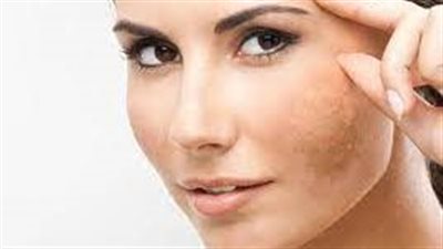 وداعاً لآثار الحمل: علاج كلف الحمل بطرق طبيعية.