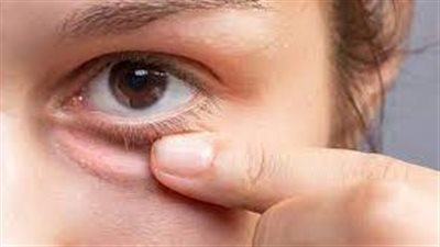 كيف تتخلص من انتفاخ العين: 5 نصائح مجربة وفعالة