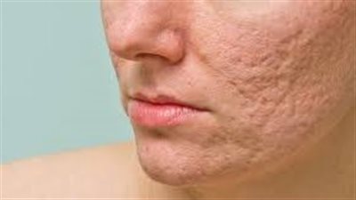 3 وصفات طبيعية من الأعشاب للتخلص من آثار حب الشباب