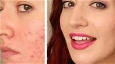 4 نصائح ذكية لمنع ظهور آثار حب الشباب على الوجه