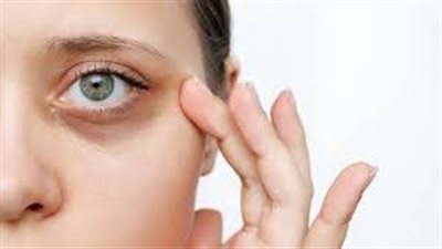 وداعاً للهالات السوداء: اكتشف أسبابها وطرق علاجها